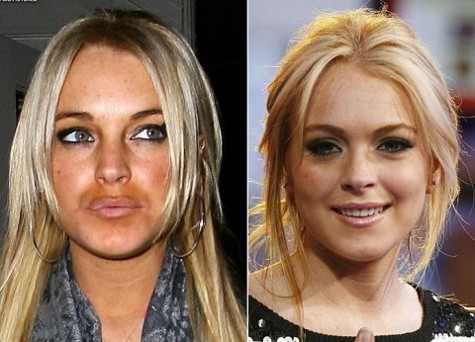 Labios operados de Lindsay Lohan